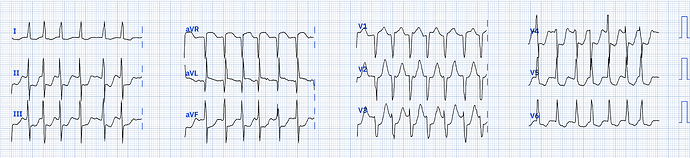 240815 EKG