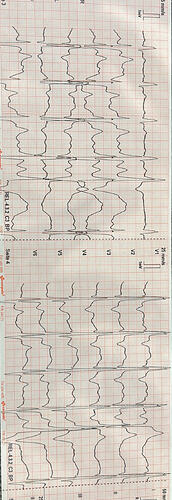EKG